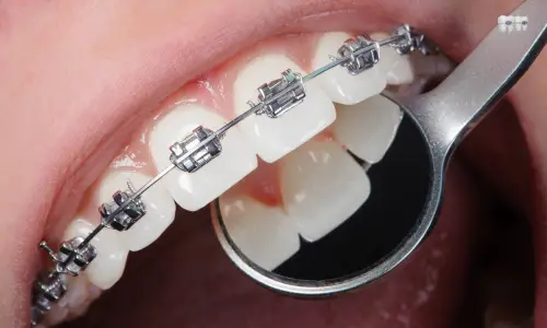 aparelho dental autoligado