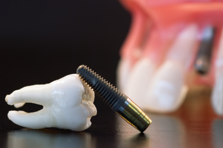 Implantes Dentários