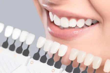 Clareamento Dental